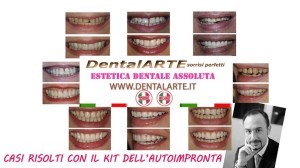 faccette dentali