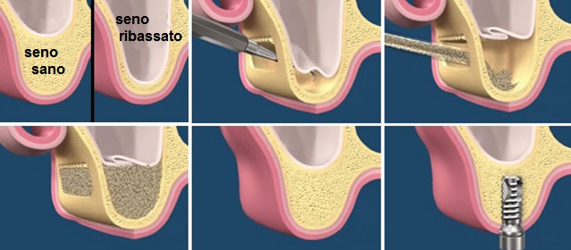 innesto osseo