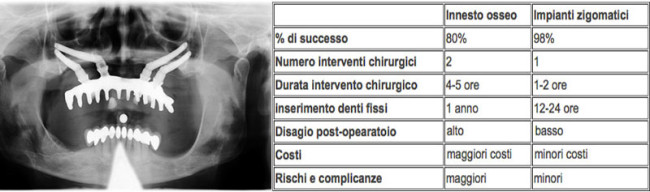zigomatici